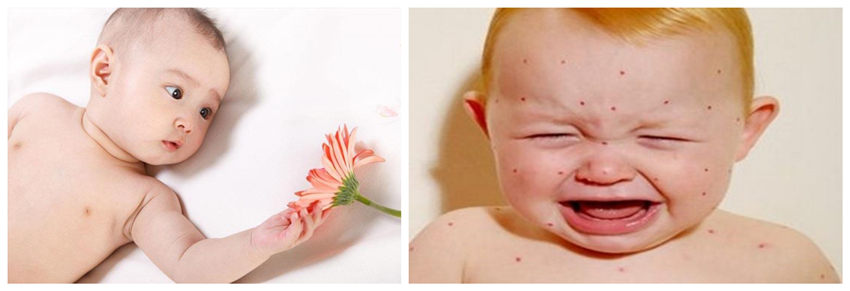 兒童濕疹反反復復，您有在家安裝家用除濕產品嗎？